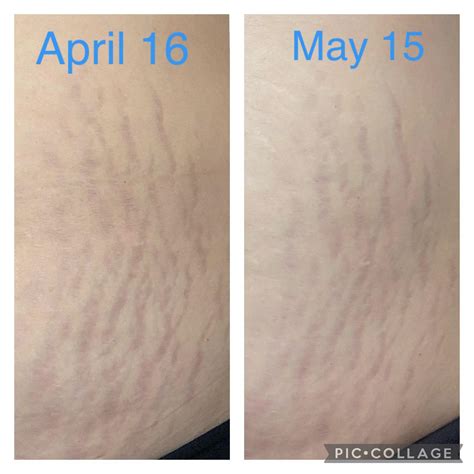 Retin A Before And After Stretch Marks