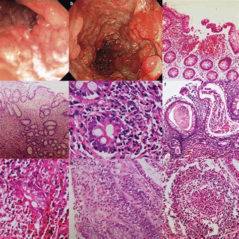 Colonic Tuberculosis Mimicking Crohn S Disease Case Report Bmc