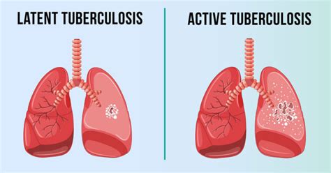 Tuberculosis Tb Types Symptoms Causes And Prevention Remedy Space