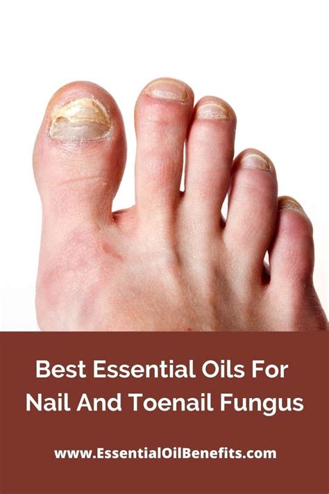 Best Essential Oils For Nail And Toenail Fungus Essential Oil
