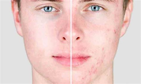 Acne Vulgaris What Is Av Terminology And Goals Of Therapy