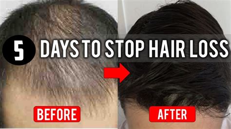 How To Stop Hair Loss And Things To Avoid If You Re Experiencing Hair