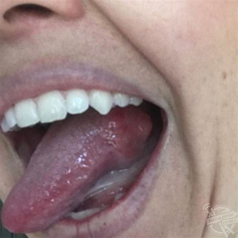 this mum had a shock when a bump on her tongue ended up being cancer media drum world