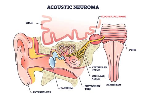 Acoustic Neuroma Doctor Philadelphia