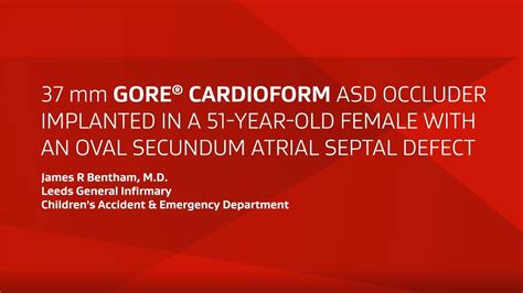 Gore Cardioform Asd Occluder Implant In An Oval Secundum Asd Youtube