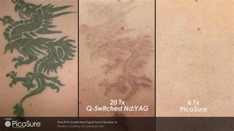 Laser Tattoo Removal You Can Be Sure Of With Picosure Norah Clair Aesthetics