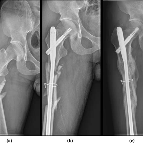 A A Comminuted Femoral Shaft Fracture With Displaced Major Fragments B