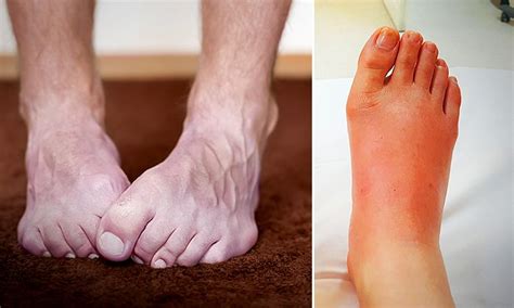 10 Things Your Feet Reveal About Your Health Eg Swollen Feet Purple