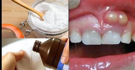 Remèdes Naturels Vous Pouvez Guérir Un Abcès Dentaire Naturellement