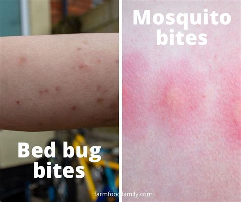 Bed Bug Bites Vs Mosquito Bites Similarities And Differences Photos