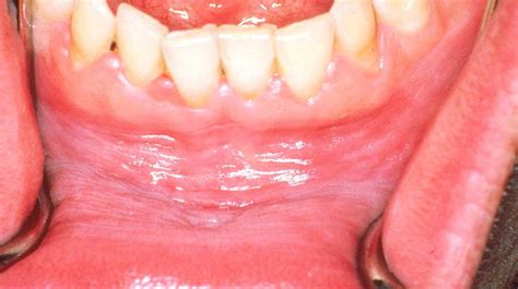 White Gums Causes Treatments And More Healthy Lifestyle