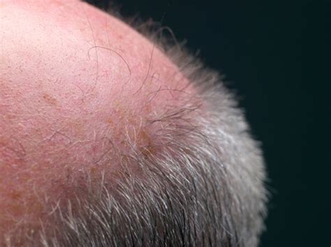 Red Blotches On The Scalp