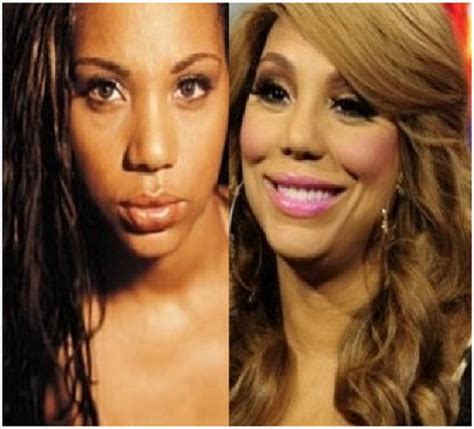 Top 18 Celebs With Plastic Surgery