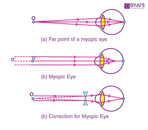 Defects Of Vision And Their Correction Myopia Hypermetropia