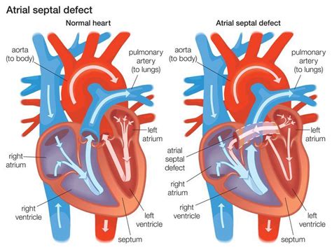 Atrial Septal Defect Is A Congenital Heart Problem Found In Newborns