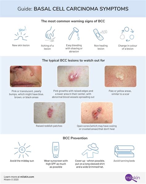 Skin Cancer Types Basal Cell Carcinoma Bcc Squamous Cell Carcinoma