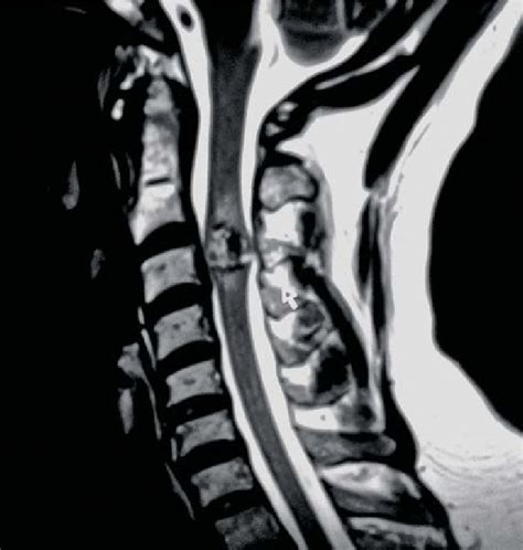 Cervical Spine Mri The T Weighted Mid Sagittal View A Reveals A The Best Porn Website