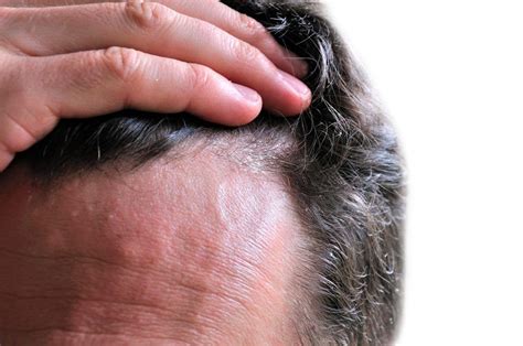 Qué es la seborrea causas y tratamiento para mejorar el cabello