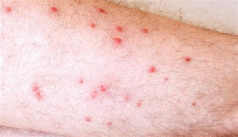 Or a tiny brown bump? Red Spots on Legs Causes: Small, Raised, Flat or Itchy ...