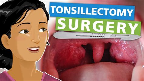 Tonsillectomy Surgery Youtube