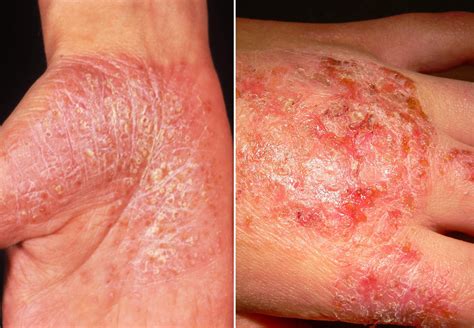 Eczemas En La Piel Fotos F