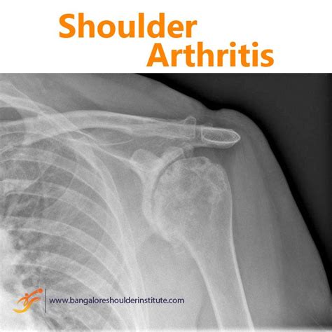 Shoulder Arthritis Shoulder Arthritis Arthritis Shoulder