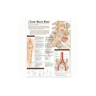 Understanding Low Back Pain Chart Poster Laminated The Best Porn Website
