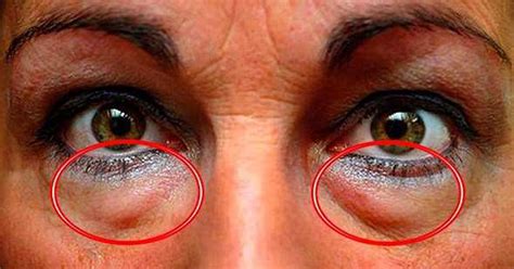 Dark Circles And Bags Under The Eyes Can Disappear By Using This