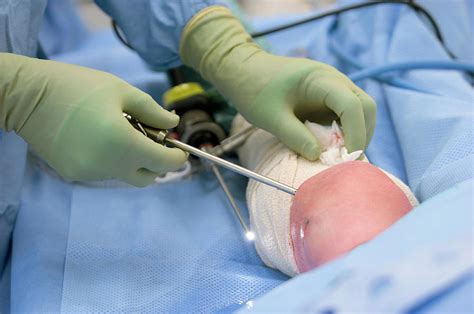 Knee Biopsy Surgery Photograph By Jim Varney Science Photo Library