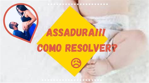 Assadura em Bebê Como tratar assadura cuidado baby YouTube