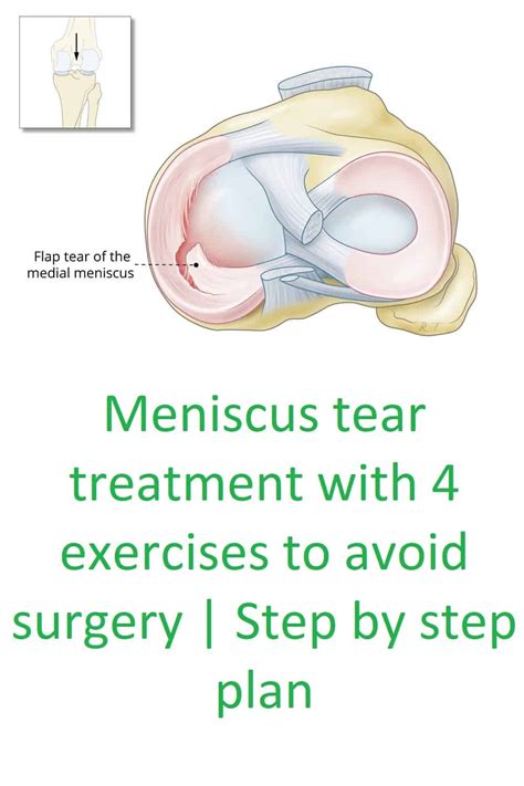 Meniscus Tear Treatment With 4 Exercises To Avoid Surgery