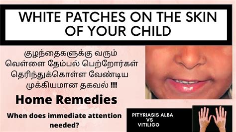 White Patchesspots On The Face Of Your Childpityriasis Alba Vs