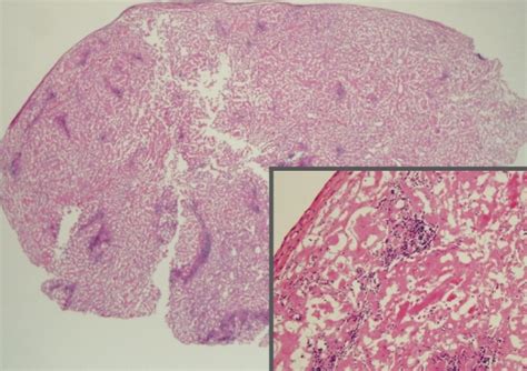 Histologic Features Of Mesenteric Lymph Node Biopsy Amyloid Deposits