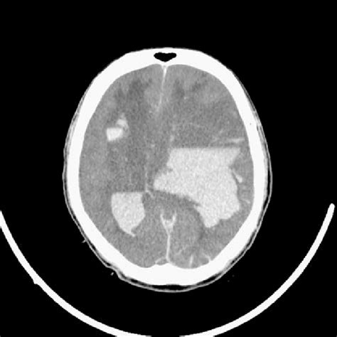 A Non Contrast Computed Tomography Image Of The Head Revealed Bilateral