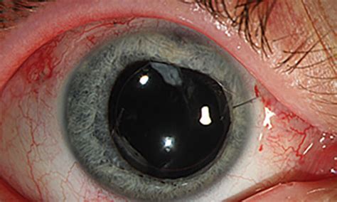 Traumatic Eye Injury From An Exploding Aerosol Can The Medical