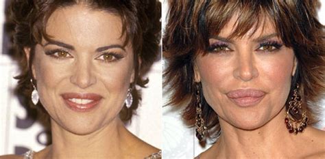 Lisa Rinna Plastic Surgery Before And After Face Photos