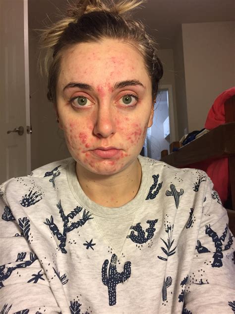 Acne Selfie From Severe Cystic Acne To Clear Skin In 9 Months
