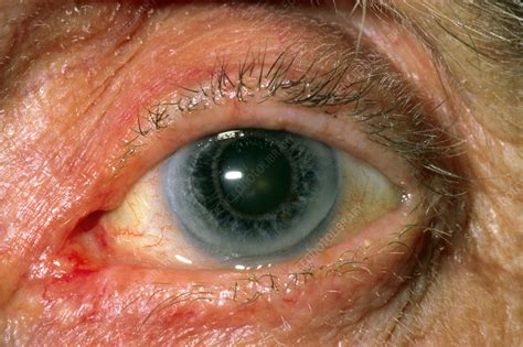 Close Up Of Patients Eye With Early Cataract Stock Image M1550375