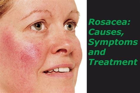 Rosacea Types Causes Symptoms Diagnosis Risk Factors