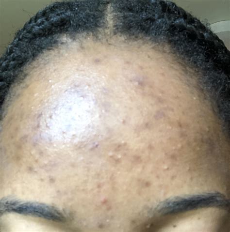 Skin Concerns Persistent Hyperpigmentation On Forehead R