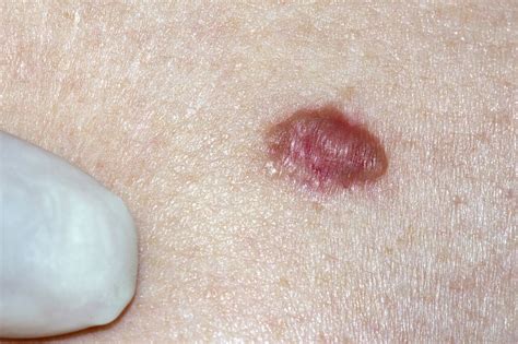 Basal Cell Carcinoma Causes Symptoms And Treatment