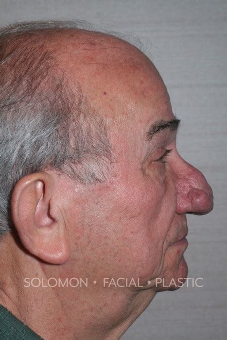 Read the jpmorgan chase annual report. Rhinophyma Before & After Photos - Dr. Solomon