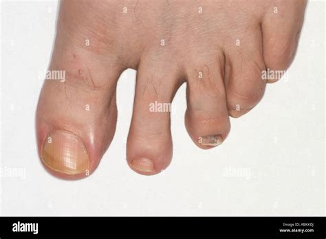 Broken Toe High Resolution Stock Photography And Images Alamy