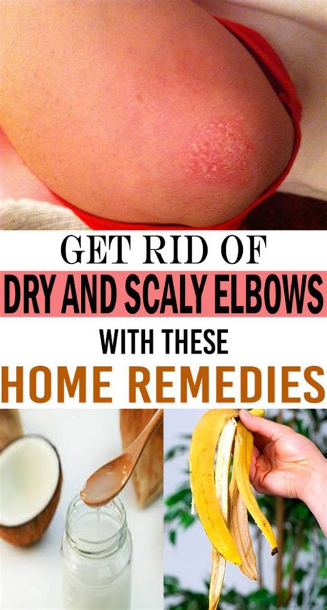 Get Rid Of Dry And Scaly Elbows With These Home Remedies Remedies