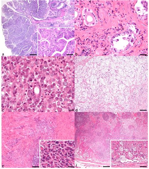 Gastric Carcinoma Subtypes And Local Lymph Node Metastasis A
