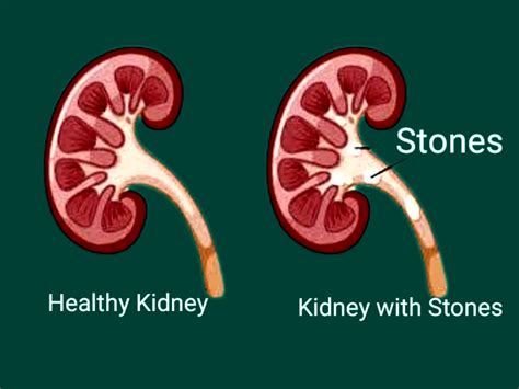 Kidney Stone Kidney Stone Symptoms Treatment And Prevention