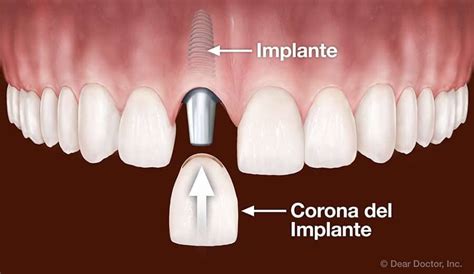 Schlichter Radar Juni que es un implante dental Hervorheben Künstlich
