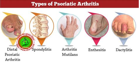 Psoriatic Arthropathy Causes Symptoms Treatment