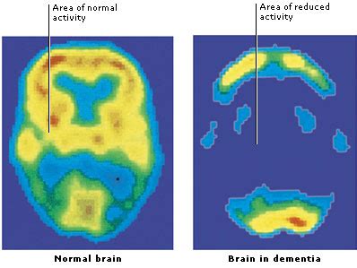 Vascular dementia may be caused by brain damage from strokes, atherosclerosis, endocarditis, or because vascular dementia is caused by the death of brain tissue and atherosclerosis, there is no. Medical Encyclopedia - Dementia - Aviva