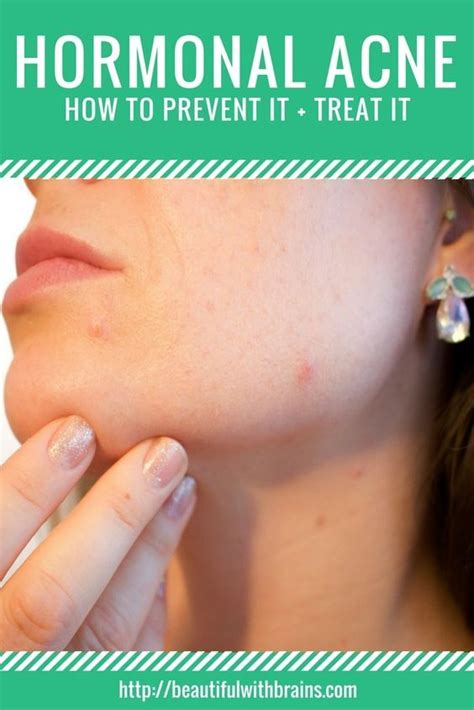 The Ultimate Guide To Dealing With Hormonal Acne Artofit